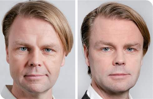 Fillerbehandlingar
